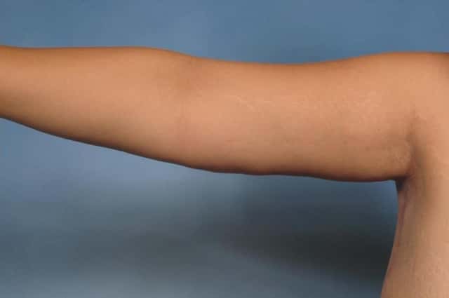 Arm Lift Before & After Case 132 after