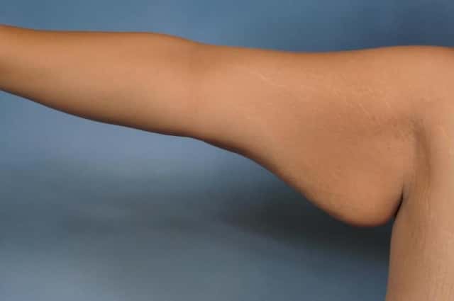 Arm Lift Before & After Case 132 before