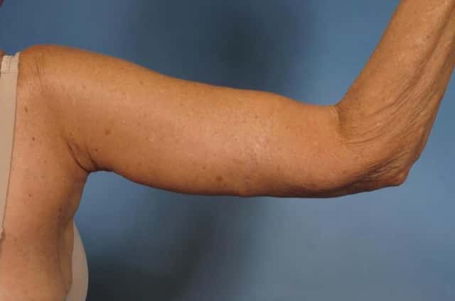 Arm Lift Before & After Case 174 after