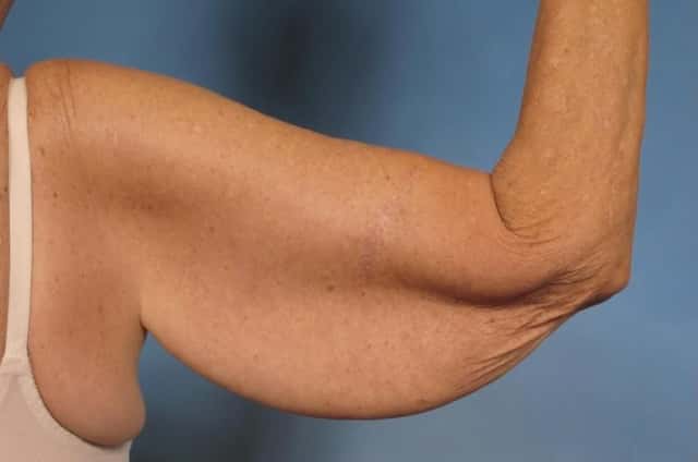Arm Lift Before & After Case 174 before
