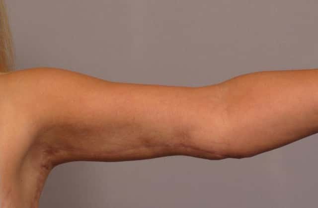 Arm Lift Before and 6 Months After, L Inner Strt