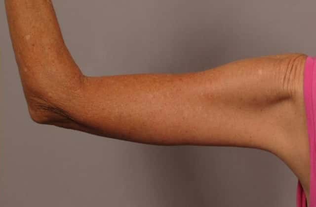 Posterior View of Left Upper Arm 6 Months After Arm Lift (Brachioplasty)