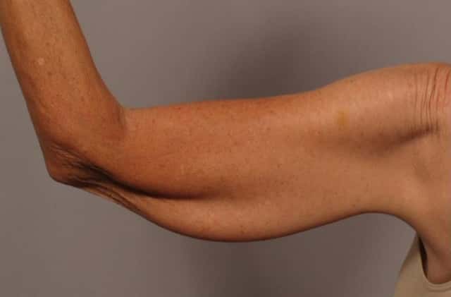 Posterior View of Left Upper Arm Before Arm Lift (Brachioplasty)