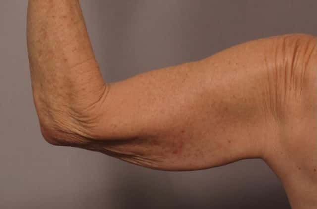 Posterior View of Left Upper Arm Before Arm Lift (Brachioplasty)