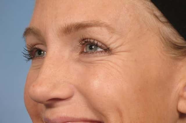 BOTOX® Cosmetic Before & After Case 20 before