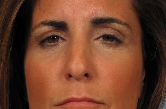 BOTOX® Cosmetic Before & After Case 248 after