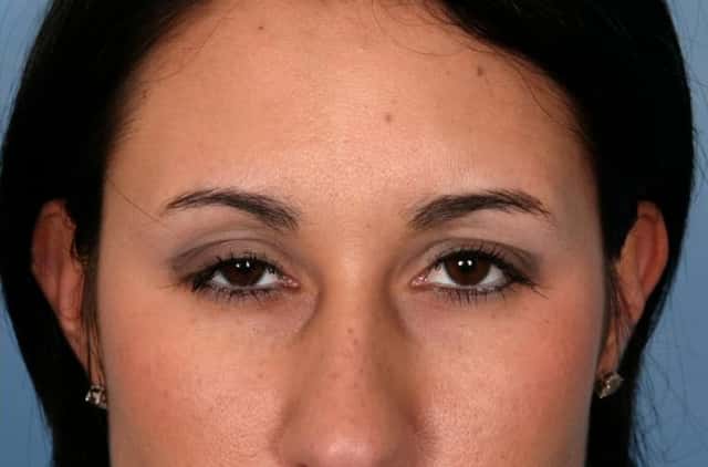 BOTOX® Cosmetic Before & After Case 57 after