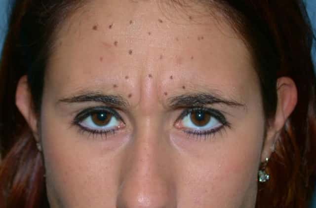 BOTOX® Cosmetic Before & After Case 57 before