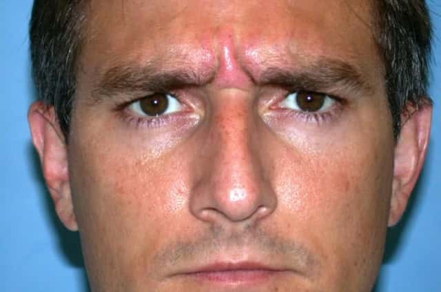BOTOX® Cosmetic Before & After Case 58 before