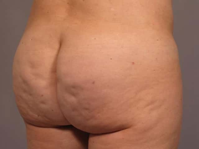 Brazilian Butt Lift Before & After Case 293 after