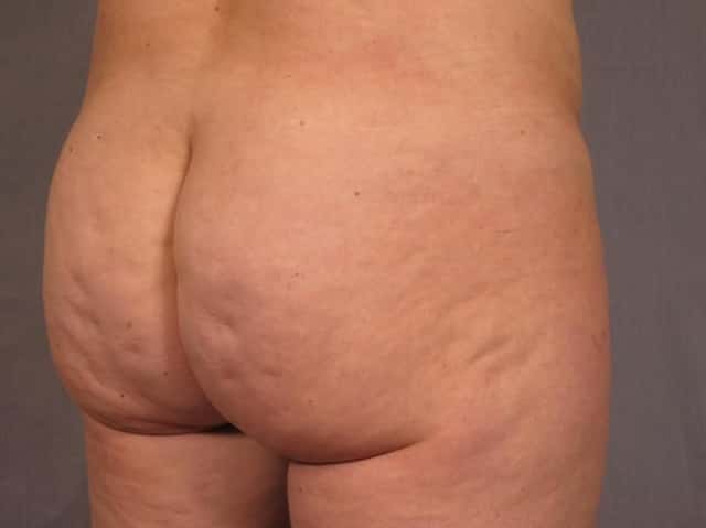 Brazilian Butt Lift Before & After Case 293 before