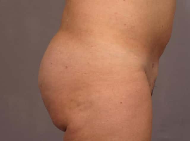 Brazilian Butt Lift Before & After Case 293 after