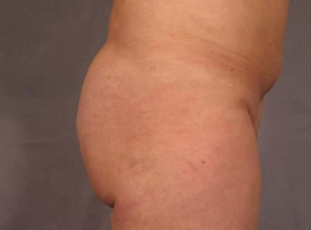 Brazilian Butt Lift Before & After Case 293 before