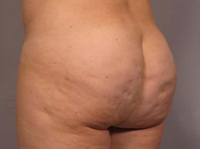 Brazilian Butt Lift Before & After Case 293 after