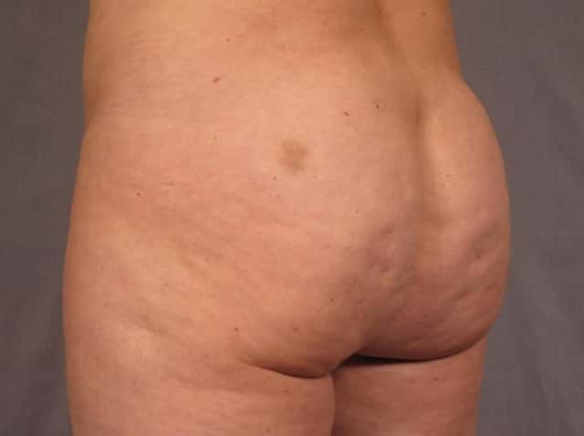 Brazilian Butt Lift Before & After Case 293 before