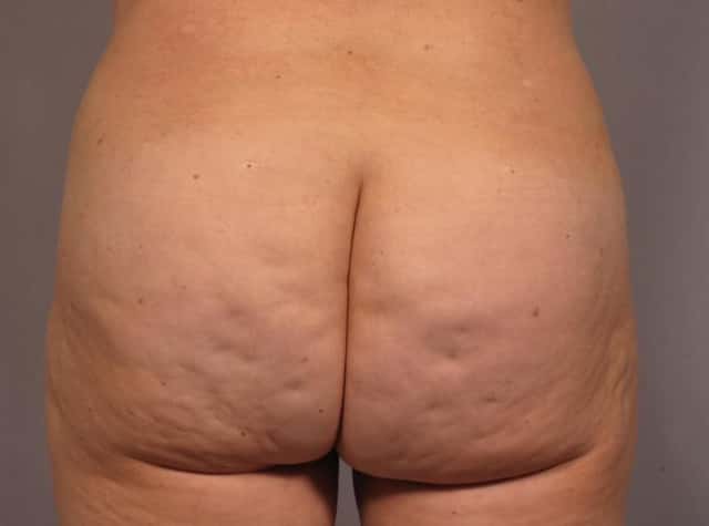 Brazilian Butt Lift Before & After Case 293 after