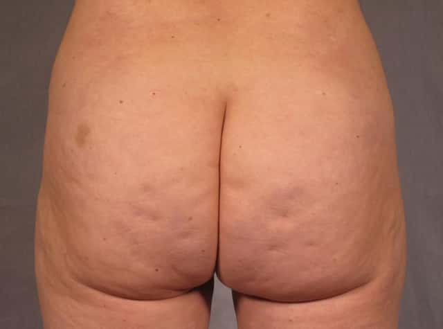 Brazilian Butt Lift Before & After Case 293 before