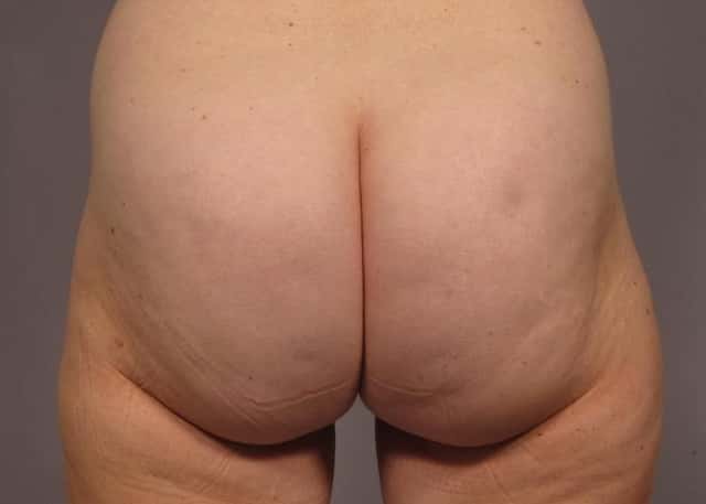 Brazilian Butt Lift Before & After Case 312 after