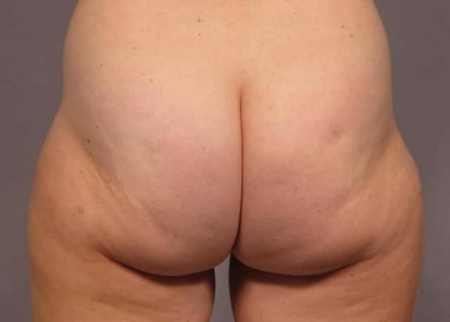 Brazilian Butt Lift Before & After Case 312 before