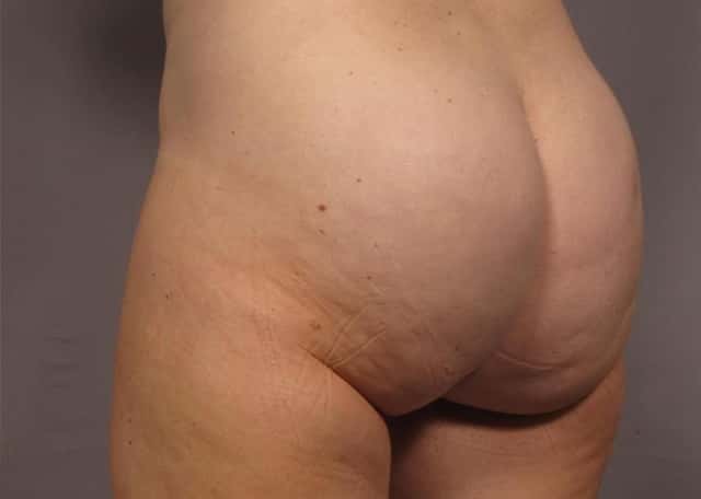 Brazilian Butt Lift Before & After Case 312 after