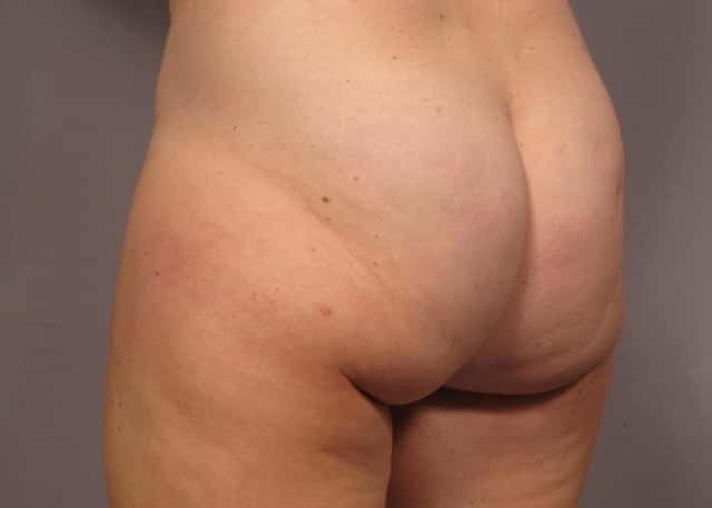 Brazilian Butt Lift Before & After Case 312 before
