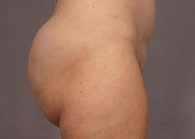 Brazilian Butt Lift Before & After Case 312 after