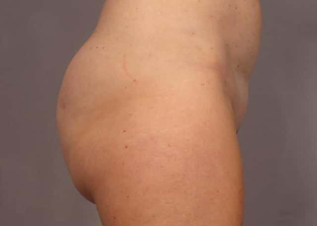 Brazilian Butt Lift Before & After Case 312 before
