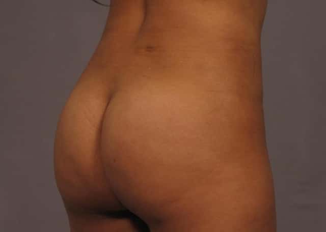 Brazilian Butt Lift Before & After Case 319 after