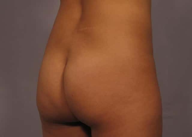 Brazilian Butt Lift Before & After Case 319 before