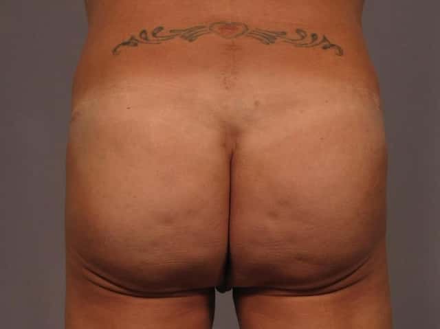Brazilian Butt Lift Before & After Case 328 after