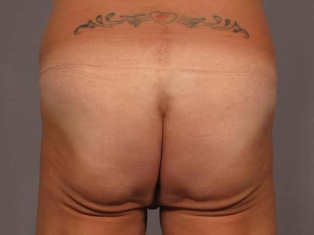 Brazilian Butt Lift Before & After Case 328 before