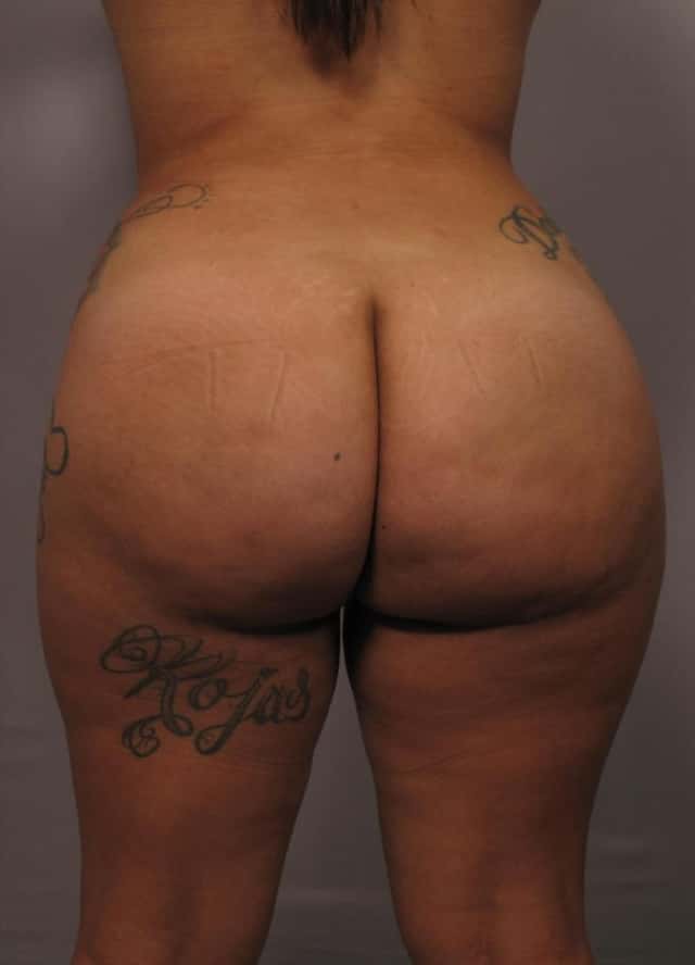 Brazilian Butt Lift, Posterior 3 Months After 1 L Fat