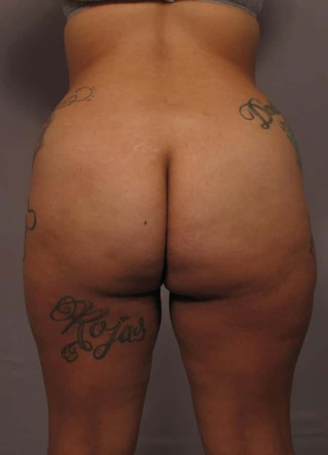 Brazilian Butt Lift, Posterior Before