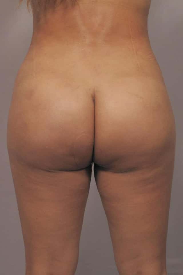 SW FL woman 3 Weeks Post BBL posterior view