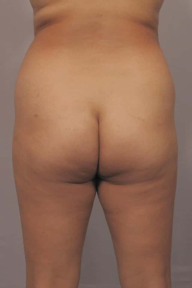 SW FL woman pre BBL posterior view