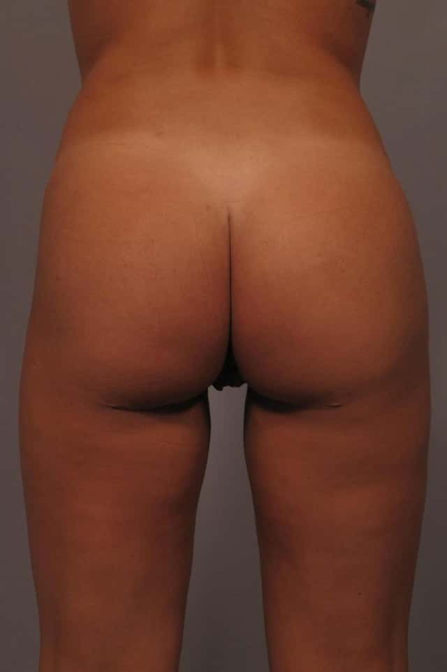 Posterior View of Brazilian Butt Lift in Naples, Florida, 3 Years Post
