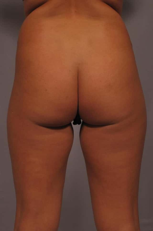 Posterior View of Brazilian Butt Lift in Naples, Florida, pre