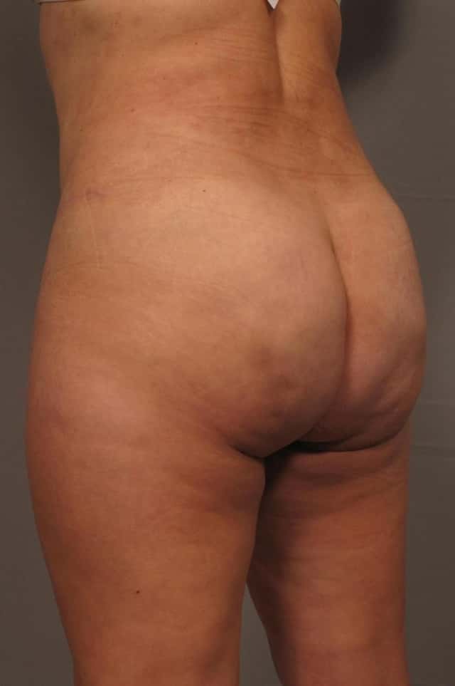 Left Oblique 6-month post-op photo of Brazilian Butt Lift