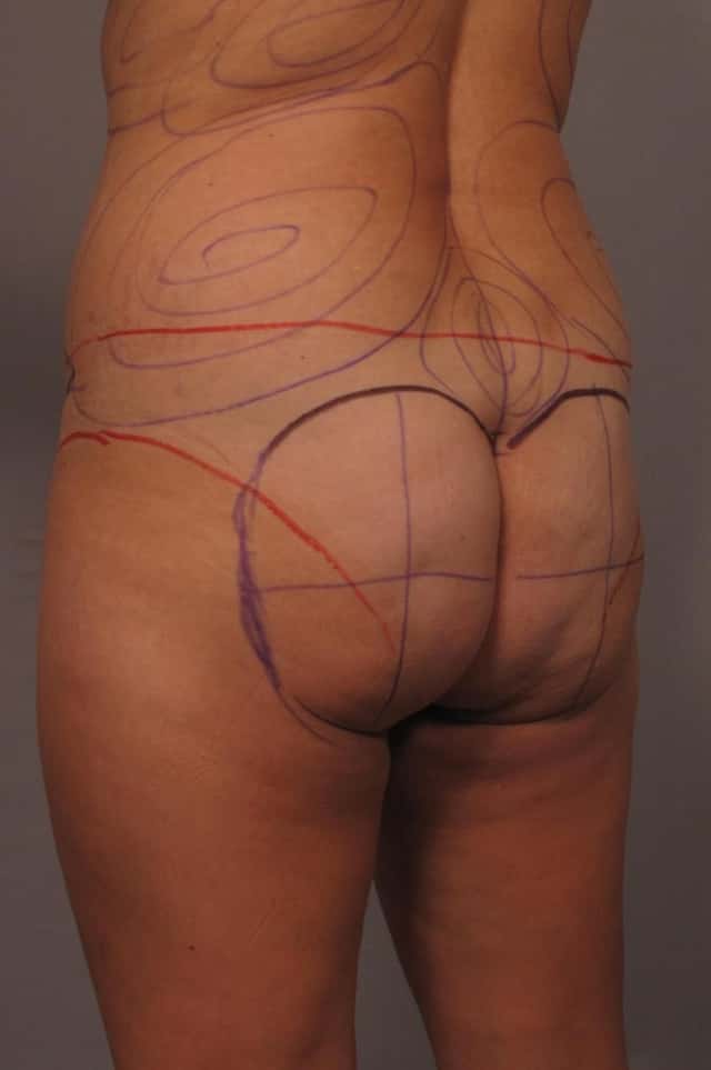 Left Oblique pre-op photo of Brazilian Butt Lift