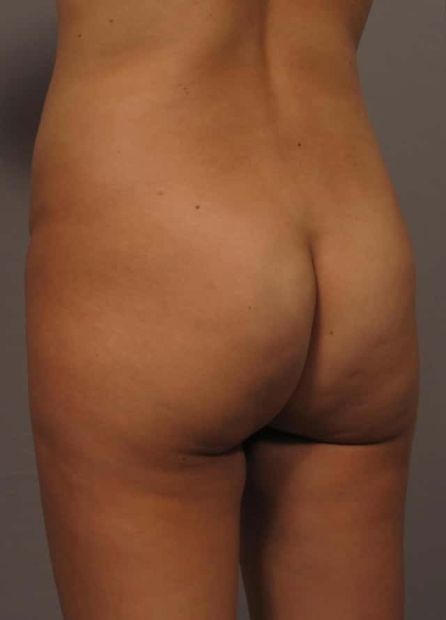 Left Oblique view of BBL in Naples, pre-op