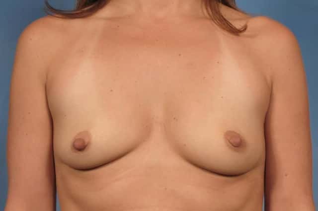 Breast Augmentation Before & After Case 117 before