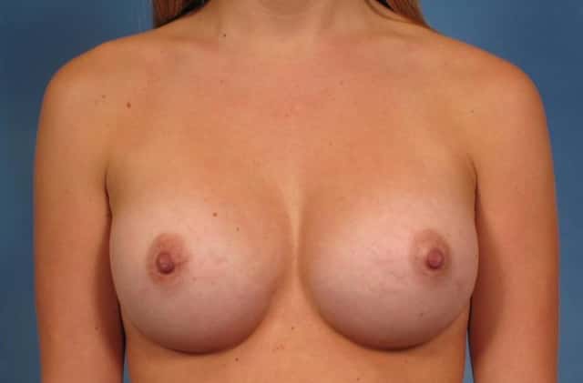 Breast Augmentation Before & After Case 144 after
