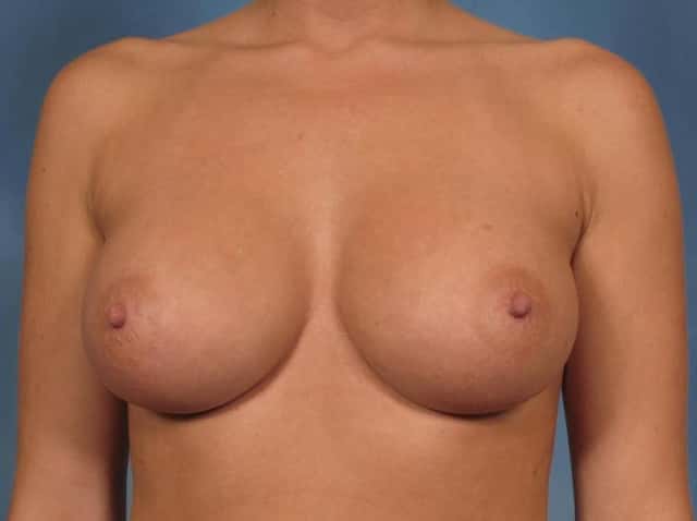 Breast Augmentation Before & After Case 158 after