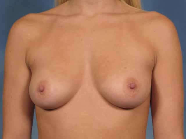 Breast Augmentation Before & After Case 158 before