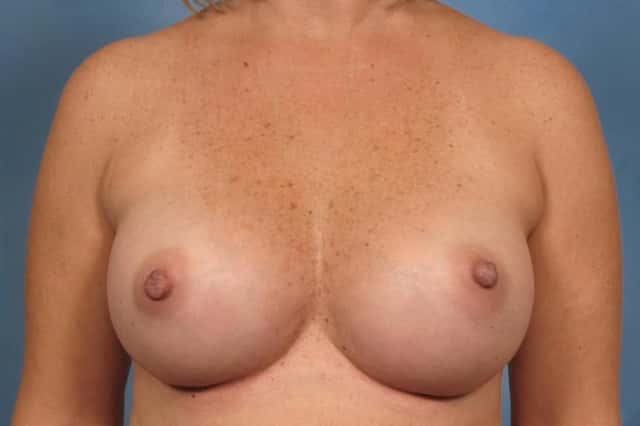 Breast Augmentation Before & After Case 160 after