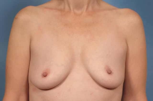 Breast Augmentation Before & After Case 162 before