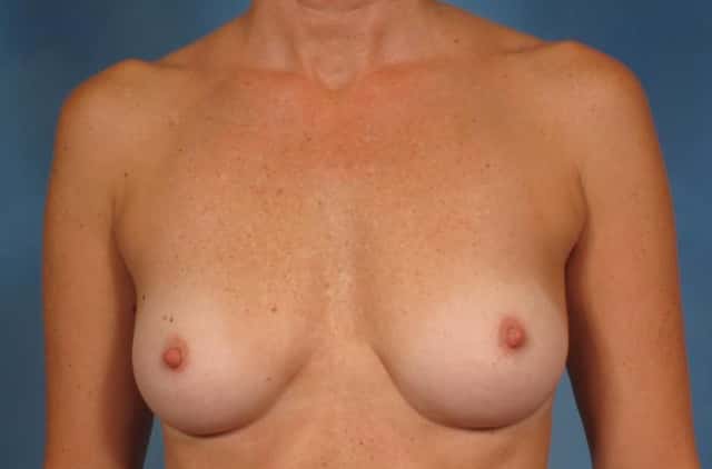 Breast Augmentation Before & After Case 197 before
