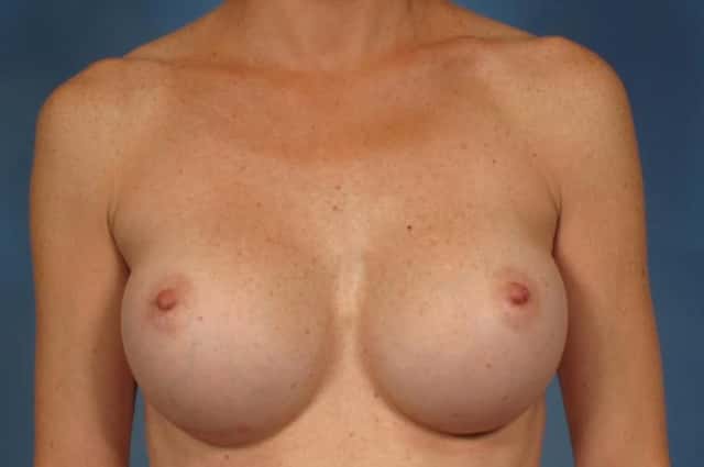Breast Augmentation Before & After Case 228 before
