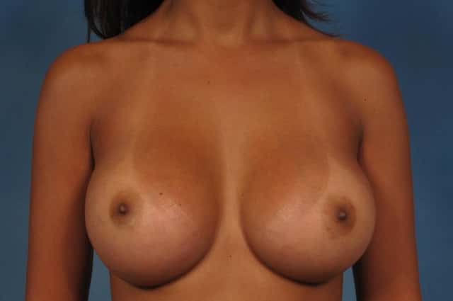 Breast Augmentation Before & After Case 233 after