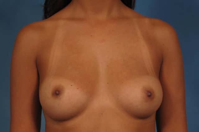 Breast Augmentation Before & After Case 233 before